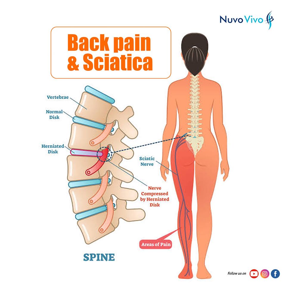 Back-pain-and-Sciatica