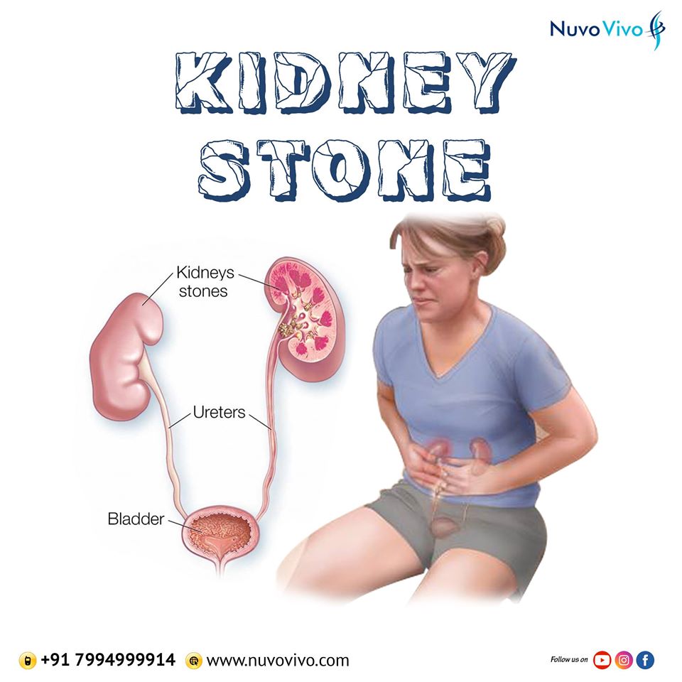 Read more about the article Kidney Stone