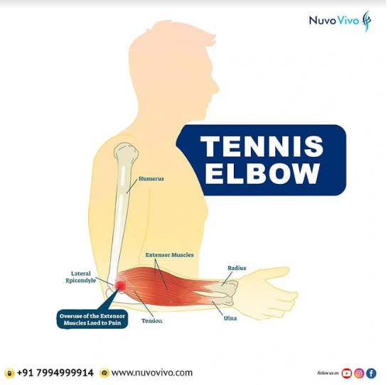 Tennis-Elbow