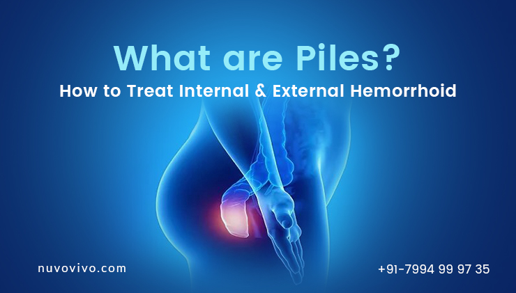 What-are-PIles-How-to-treat-internal-and-external-hemorroid