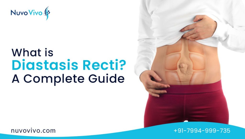 What-is-Diastasis-Recti-A-Complete-guide